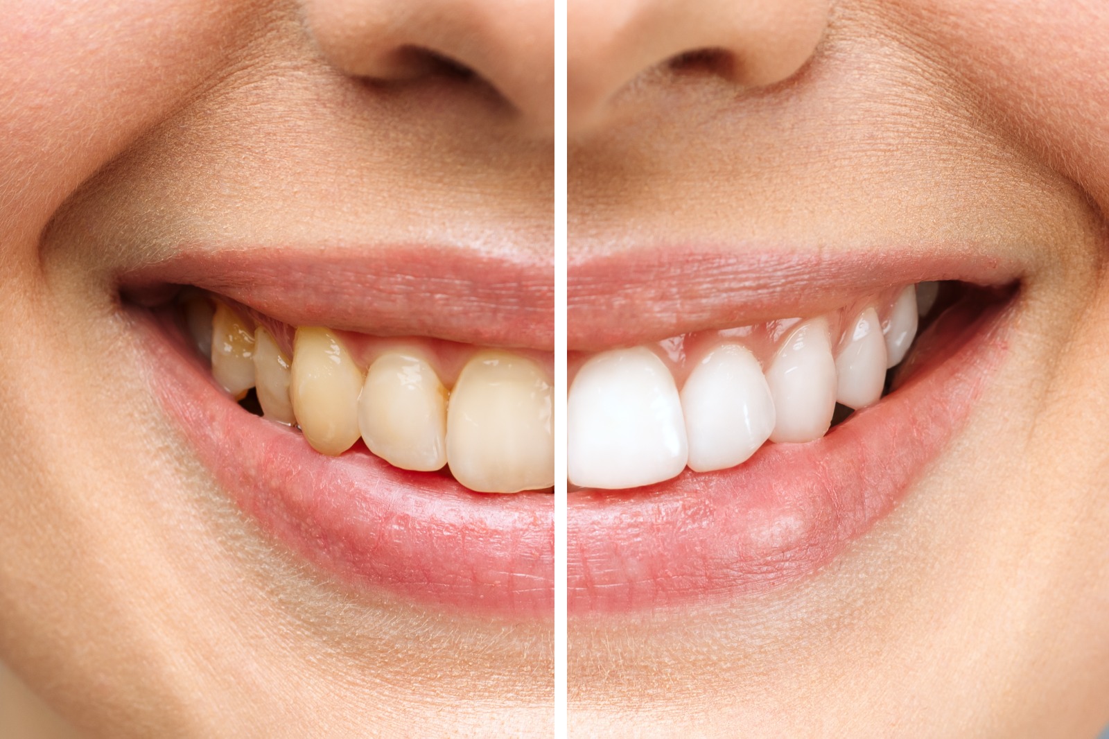 Clareamento Dental